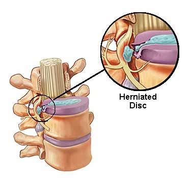 lumbar herniated disc risk factors diagnosis treatments