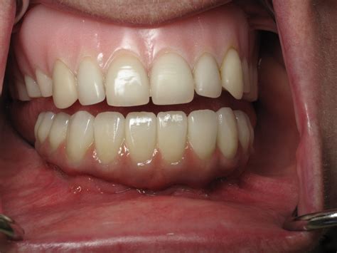 pull    teeth   dental implants ramsey  amin dds