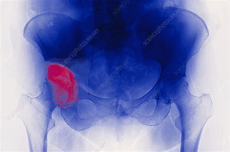 hip osteoarthritis stock image  science photo library