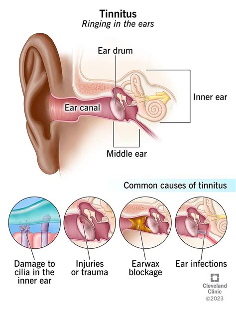tinnitus ringing  ears  treatment