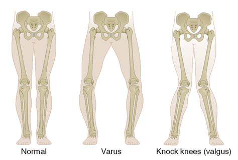 valgus  varus knee alignment difference