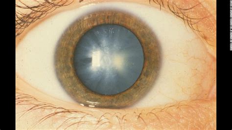 7 health problems predicted with a look into your eyes cnn