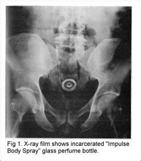 22 objets improbables trouvés dans le rectum de personnes page 2