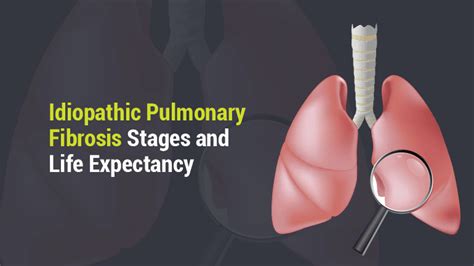 Idiopathic Pulmonary Fibrosis Stages And Life Expectancy