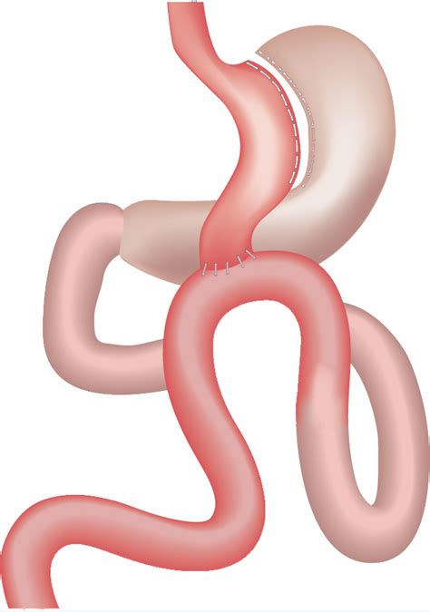 Consensus Survey On Mini Gastric Bypass And One