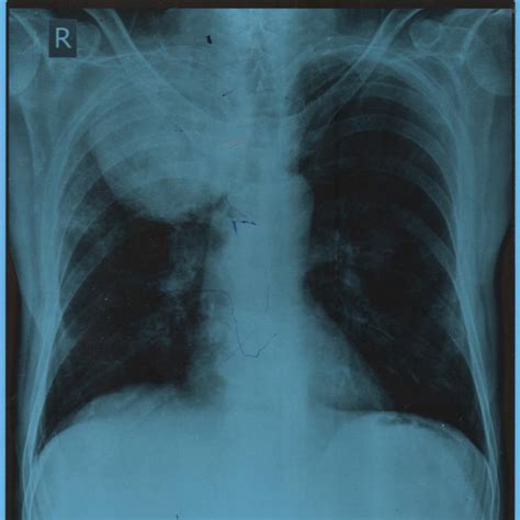 Chest X Ray Showing A Mass In Right Upper Lobe Download Scientific