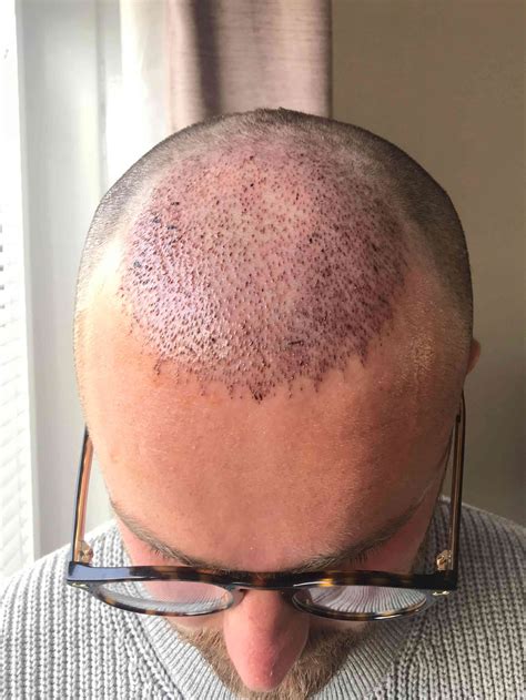 post op recovery photographs 2 weeks after fue hair transplant procedure