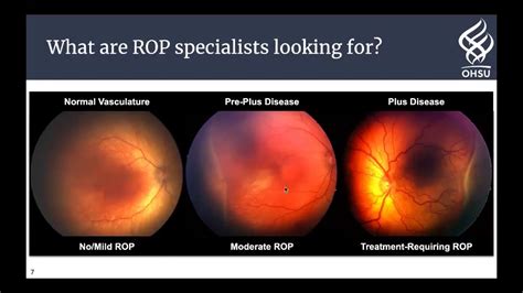 machine learning  disease detection  prediction  retinopathy