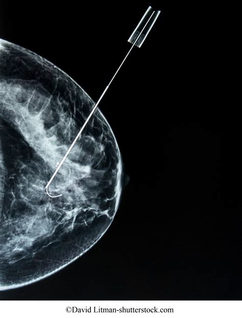 câncer de mama homens mulheres prevenção mamografia