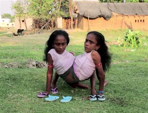 conjoined sisters find love with the same man