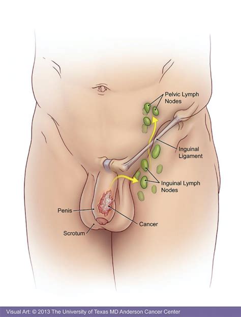 Penile And Anal Cancers Sexinfo Online