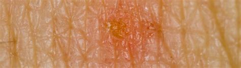 scratching scabies   worse