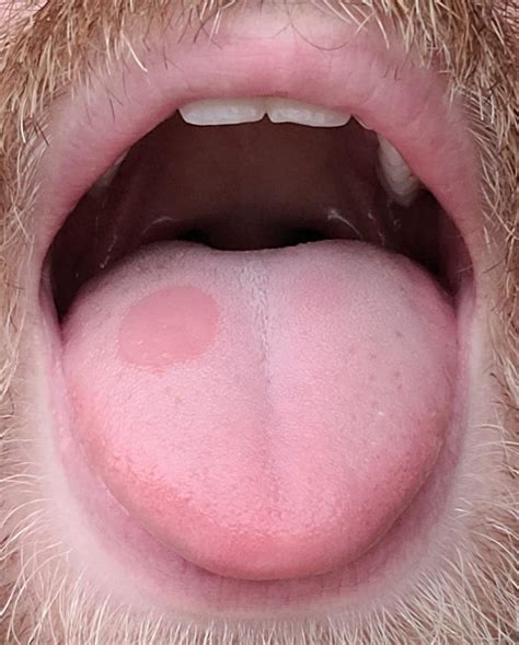 red spot  tongue    growing     checked      rmedical