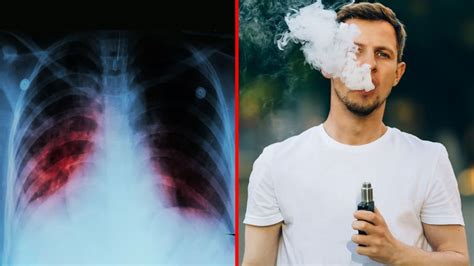 cdc warns against the dangers of vaping after recent spike in lung