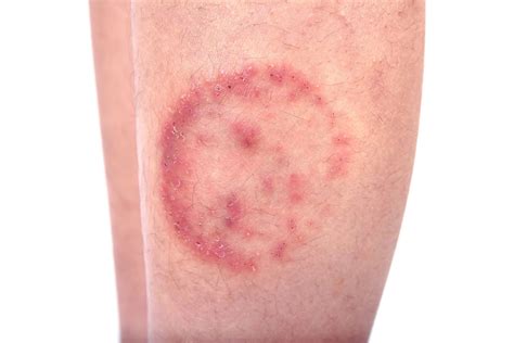 ringworm  symptoms treatment britannica