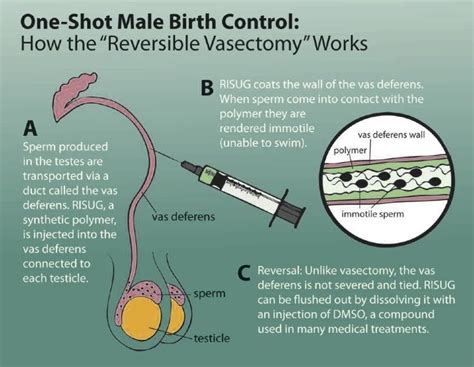 reversible vasectomy another option for male contraception modern