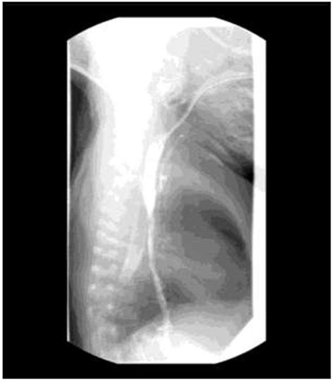 Delayed Diagnosis Of High Proximal Tracheoesophageal Fistula In