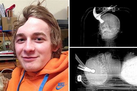 Gay Mans Head Smashed With Hammer By Flatmate [graphic Photos] The Trent