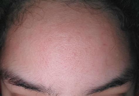 skin concerns  forehead     weird texture  feels   tight