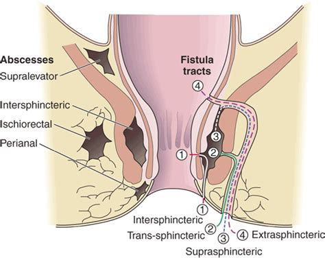 Perineal perianal abcess picture
