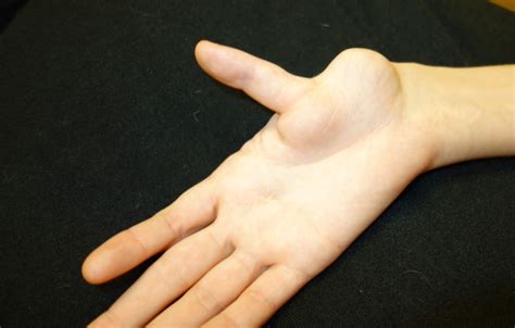 thumb deformity  untreated thumb hypoplasia congenital hand  arm differences washington