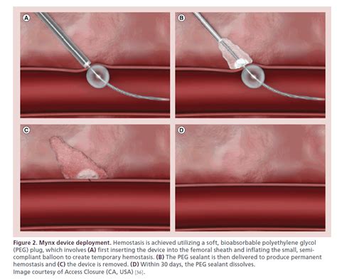 mynx interventional cardiology interventional cardiology cardiac