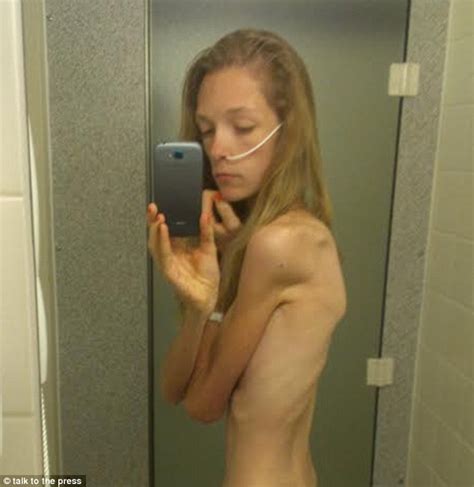 ela chegou a pesar só 30kg e hoje faz campanha contra anorexia