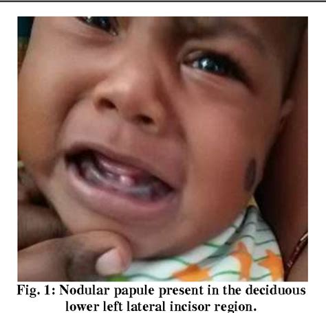dental lamina cyst   newborn infant  rare case report semantic scholar