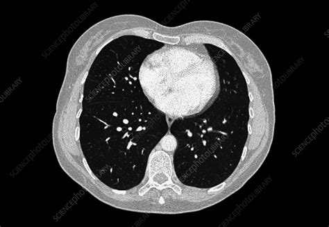 Normal Lungs And Heart Ct Scan Stock Image C001 8066 Science