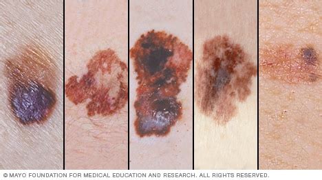 presentacion de diapositivas las imagenes de melanomas ayudan