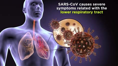 severe acute respiratory syndrome sars   severe respiratory