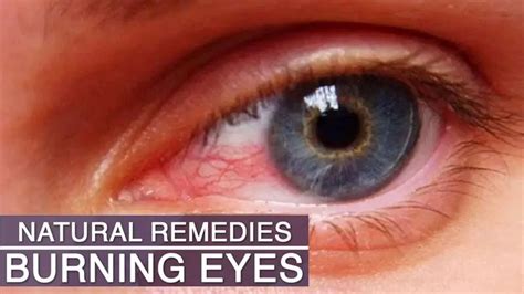 What Causes Burning Eyes And Fatigue