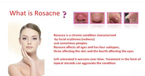 rosacea treatment pictures causes diet and triggers