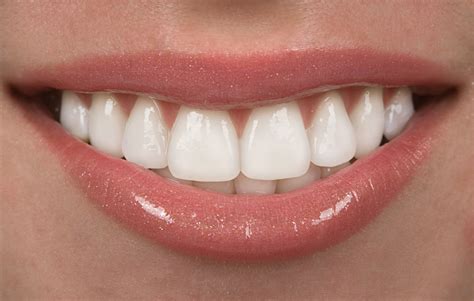 composite vs porcelain what kind of veneers are right for you
