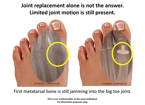 big toe joint pain limitedpainful motion hyprocure  proven solution  misaligned feet