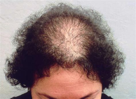 hair loss  women men  diagnosis hair loss treatment