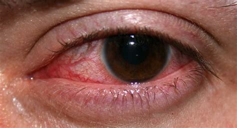 Eye Infections Conditions Eye Health Central