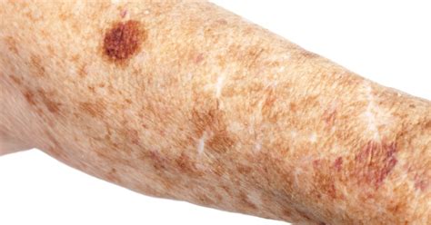 remove liver spots naturally livestrongcom