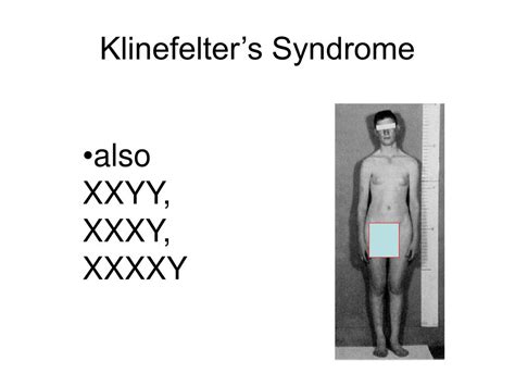 Klinefelter S Syndrome Xxy Ideas Klinefelter Syndrome Chromosome My