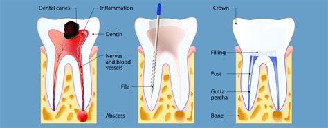 root canal therapy pike creek dental