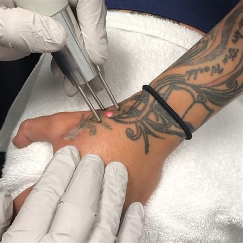 tattoo removal tattoo cares