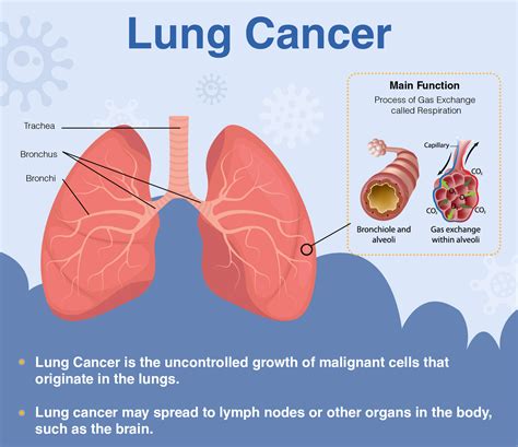 overview  lung cancer signs symptoms diagnosis treatment