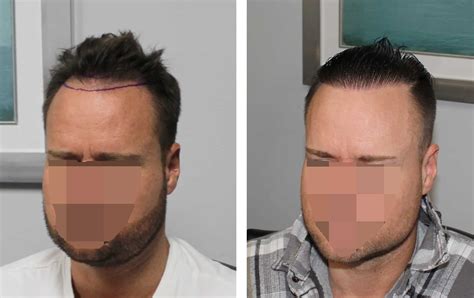 hairline surgery safety  hair transplant riset