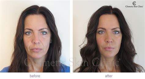 Non Surgical Facelifts And Y Lift Treatment