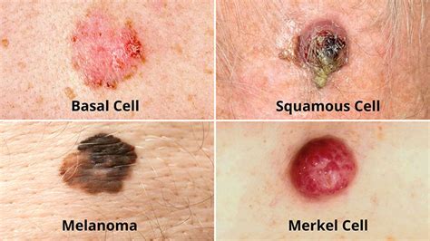 All Skin Cancer Articles Page 2 Everyday Health