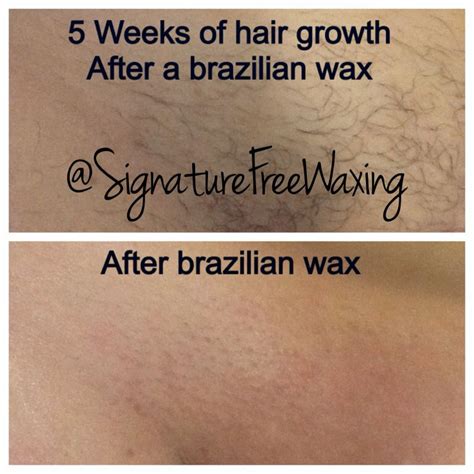 Brazilian Waxing Photos Before And After
