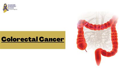 Best Cancer Hospital For Colorectal Cancer Treatment By
