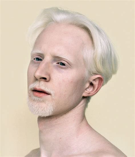 albino white hair