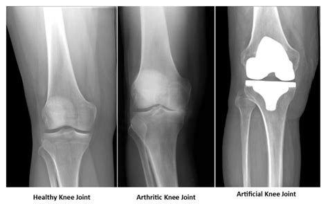 total knee replacement knee replacement knee replacement surgery
