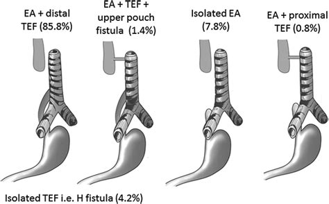 Major Anatomical Configurations Of Esophageal Atresia And Download